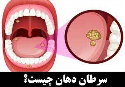 سرطان دهان یا سرطان کام چیست؟