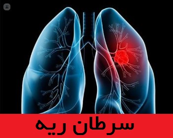 سرطان ریه چیست؟