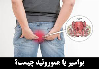 بواسیر یا هموروئید (hemorrhoid) چیست؟
