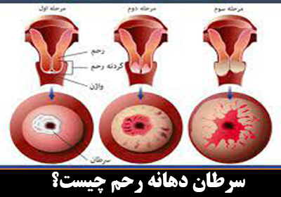 سرطان دهانه رحم چیست؟