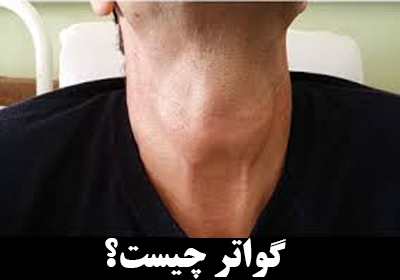 گواتر (Goiter) چیست؟