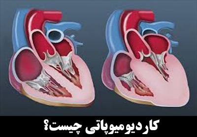 کاردیومیوپاتی چیست؟