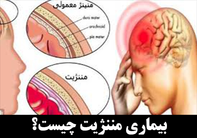 بیماری مننژیت چیست؟