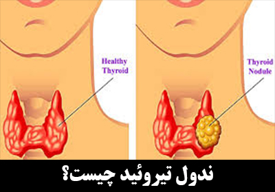 ندول تیروئید (Thyroid Nodule) چیست؟