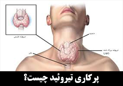 پرکاری تیروئید چیست؟