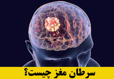 تومور مغزی یا سرطان مغز چیست؟