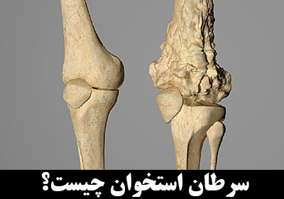 سرطان استخوان چیست؟