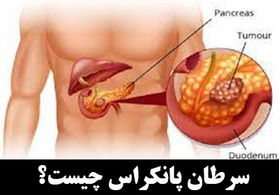 سرطان لوزالمعده یا سرطان پانکراس چیست؟