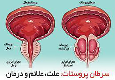 سرطان پروستات چیست؟