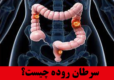 سرطان روده چیست؟ علل و درمان