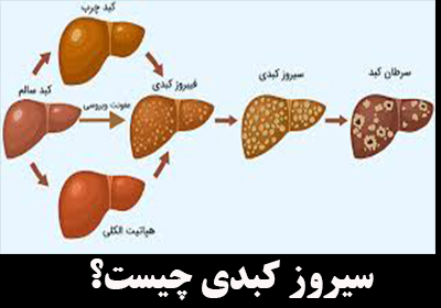 سیروز کبدی چیست؟