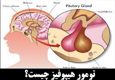 تومور هیپوفیز چیست؟